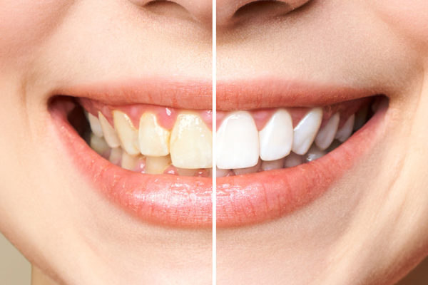 woman teeth before and after whitening. Over white background. Dental clinic patient. Image symbolizes oral care dentistry, stomatology.